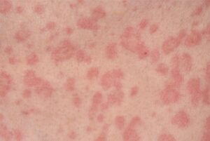 skin rash plumbing